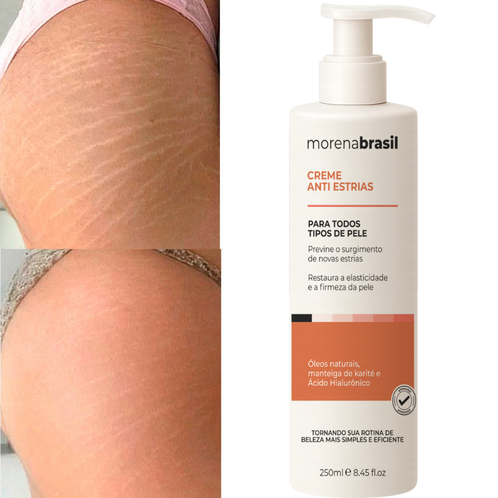 🔥 Creme AntiEstrias Removedor Estrias 200g Morena Brasil – Ação Poderosa com Colágeno e Elastina